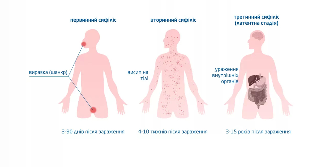 Діагностика і лікування сифілісу